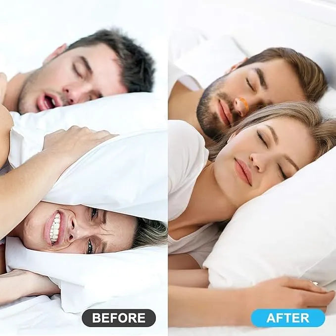 Magnetic Nasal Dilator - 15 Pairs
