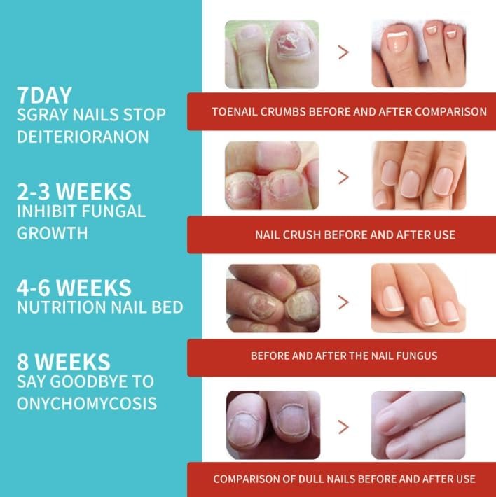 Fungal Nail Patch - 16 Pcs
